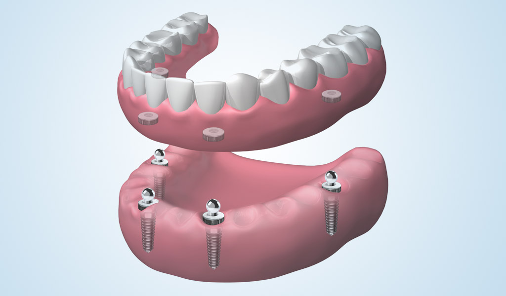 dentadura completa extraíble