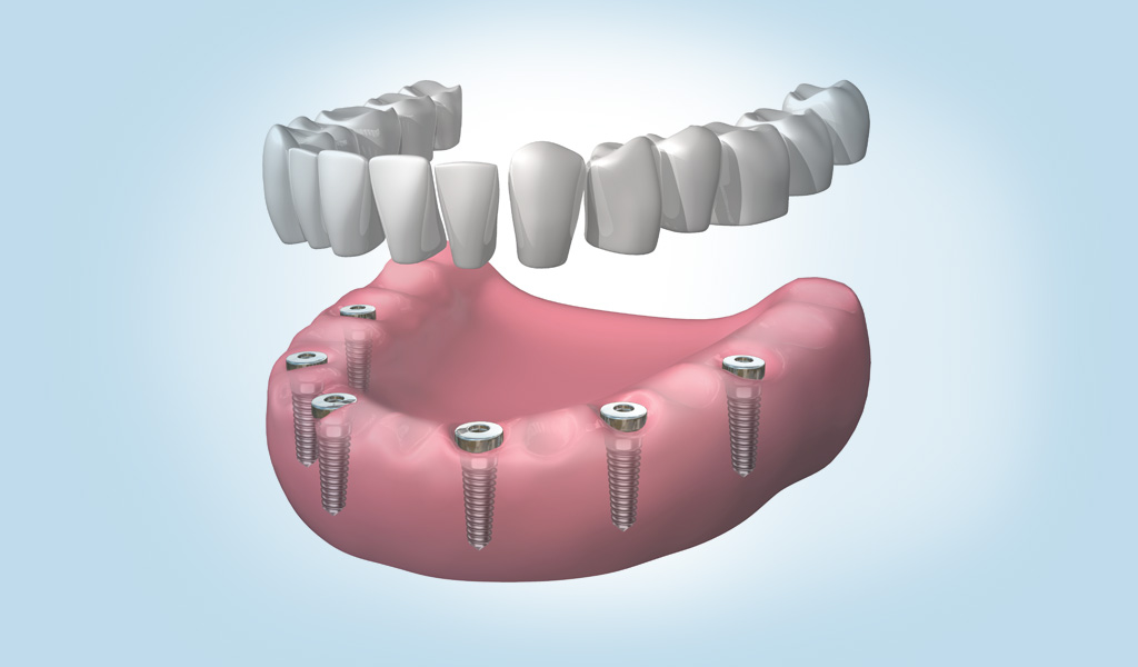 dentadura completa fija