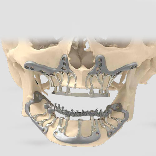 implantes subperiósticos